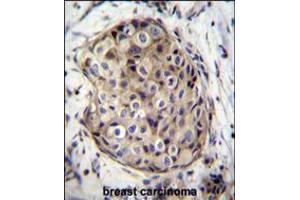 GMPR Antibody immunohistochemistry analysis in formalin fixed and paraffin embedded human breast carcinoma followed by peroxidase conjugation of the secondary antibody and DAB staining. (NT5C2 抗体  (C-Term))