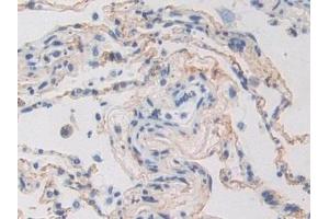 Detection of POSTN in Human Lung cancer Tissue using Polyclonal Antibody to Periostin (POSTN) (Periostin 抗体  (AA 97-230))