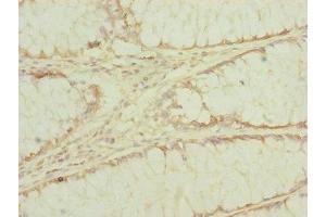 Immunohistochemistry of paraffin-embedded human colon cancer using ABIN7151546 at dilution of 1:100 (EEF1G 抗体  (AA 168-437))