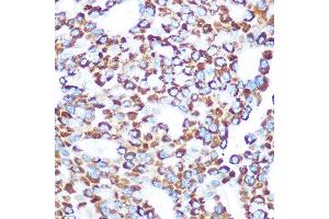 Immunohistochemistry of paraffin-embedded human liver cancer using T Rabbit pAb (ABIN7270794) at dilution of 1:100 (40x lens). (TAB3 抗体)