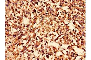 Immunohistochemistry analysis of human melanoma using ABIN7170123 at dilution of 1:100 (GLUT4 抗体  (AA 223-287))