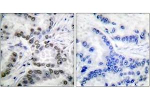 Immunohistochemistry analysis of paraffin-embedded human lung carcinoma tissue, using CBP (Acetyl-Lys1535) Antibody. (CBP 抗体  (acLys1535))
