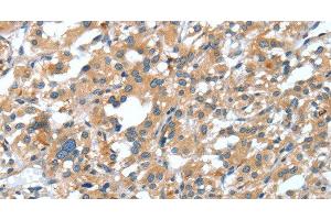 Immunohistochemistry of paraffin-embedded Human thyroid cancer tissue using DSC1 Polyclonal Antibody at dilution 1:40 (Desmocollin 1 抗体)