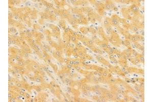 ABIN6257703 and ABIN6273923 at 1/100 staining human hepatocellular carcinoma by IHC-P.