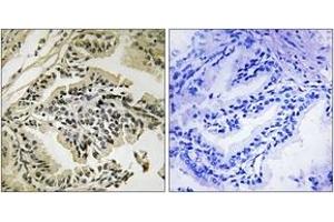 Immunohistochemistry analysis of paraffin-embedded human prostate carcinoma, using PEK/PERK (Phospho-Thr981) Antibody. (PERK 抗体  (pThr981))