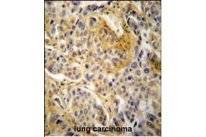 NCF1 Antibody (N-term) (ABIN652063 and ABIN2840531) immunohistochemistry analysis in formalin fixed and paraffin embedded human lung carcinoma followed by peroxidase conjugation of the secondary antibody and DAB staining. (NCF1 抗体  (N-Term))