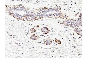 Formalin-fixed, paraffin-embedded human breast carcinoma stained with SMMHC antibody (MYH11/923). (MYH11 抗体)
