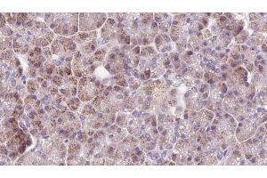 ABIN6273230 at 1/100 staining Human pancreas cancer tissue by IHC-P. (DDC 抗体  (Internal Region))