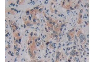 Detection of KLK2 in Human Prostate cancer Tissue using Polyclonal Antibody to Kallikrein 2 (KLK2)