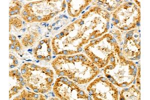 ABIN6257428 and ABIN6275868 at 1/100 staining Human kidney cancer and adjacent normal tissues by IHC-P. (CD90 抗体  (Internal Region))