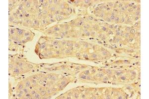 Immunohistochemistry of paraffin-embedded human liver cancer using ABIN7172023 at dilution of 1:100 (Peroxiredoxin 3 抗体  (AA 63-256))