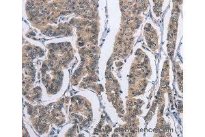 Immunohistochemistry of Human gastric cancer using DSG2 Polyclonal Antibody at dilution of 1:50 (Desmoglein 2 抗体)