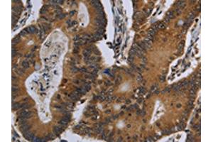 The image on the left is immunohistochemistry of paraffin-embedded Human colon cancer tissue using ABIN7129488(FGF18 Antibody) at dilution 1/20, on the right is treated with fusion protein. (FGF18 抗体)