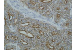 Detection of cytokeratin on paraffin-embedded sections of guinea pig breast carcinoma using anti-cytokeratin antibody (pan Keratin 抗体)