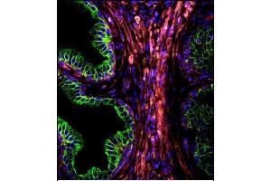 Confocal immunofluorescent analysis of CYK18 Antibody (C-term) (ABIN391561 and ABIN2841501) with prostate carcinoma followed by Alexa Fluor 488-conjugated goat anti-rabbit lgG (green). (Cytokeratin 18 抗体  (C-Term))