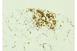 ABIN6273834 at 1/100 staining Human breast cancer tissue by IHC-P. (Kallikrein 6 抗体  (C-Term))