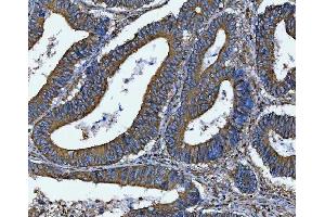 IHC analysis of DOCK180/DOCK1 using anti-DOCK180/DOCK1 antibody (ABIN7599615).