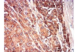 Immunohistochemical analysis of paraffin-embedded liver cancer tissues using SAA1 mouse mAb with DAB staining. (SAA1 抗体  (AA 19-212))