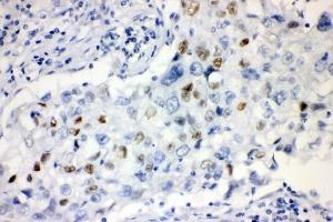 IHC analysis of CCNE1 using anti-CCNE1 antibody (ABIN7601193).
