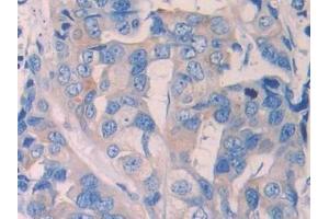 Detection of RNLS in Human Breast cancer Tissue using Polyclonal Antibody to Renalase (RNLS) (RNLS 抗体  (AA 160-319))