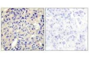 Immunohistochemistry analysis of paraffin-embedded human breast carcinoma tissue using Collagen V α2 antibody. (COL5A2 抗体)