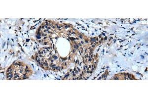 Immunohistochemistry of paraffin-embedded Human cervical cancer tissue using IQGAP1 Polyclonal Antibody at dilution of 1:30(x200) (IQGAP1 抗体)