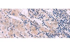 Immunohistochemistry of paraffin-embedded Human liver cancer tissue using NMRK2 Polyclonal Antibody at dilution of 1:55(x200) (ITGB1BP3 抗体)