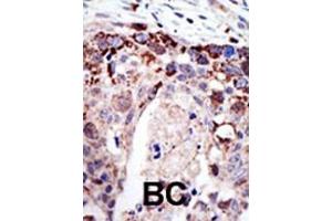 Formalin-fixed and paraffin-embedded human cancer tissue reacted with the primary antibody, which was peroxidase-conjugated to the secondary antibody, followed by AEC staining. (Ataxin 3 抗体  (N-Term))