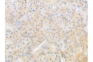 ABIN6266031 and ABIN6269398 at 1/100 staining human hepatocellular carcinoma by IHC-P. (WNK1 抗体  (N-Term))