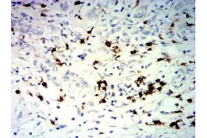 Immunohistochemical analysis of paraffin-embedded stomach cancer tissues using TNFRSF25 mouse mAb with DAB staining.