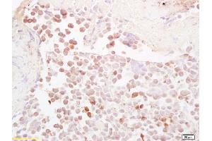 Formalin-fixed and paraffin embedded mouse colon carcinoma labeled with Anti-NQO1 Polyclonal Antibody, Unconjugated (ABIN678428) at 1:200, followed by conjugation to the secondary antibody and DAB staining (NQO1 抗体  (AA 201-274))