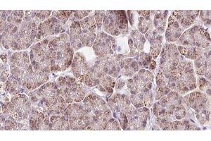 ABIN6273243 at 1/100 staining Human pancreas cancer tissue by IHC-P. (FBXO22 抗体  (Internal Region))