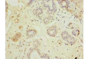 Immunohistochemistry of paraffin-embedded human breast cancer using ABIN7165622 at dilution of 1:100 (C17orf66 抗体  (AA 1-219))