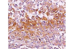 IHC testing of melanoma tissue stained with Melanoma antibody (NKI-beteb). (Melanoma 抗体)