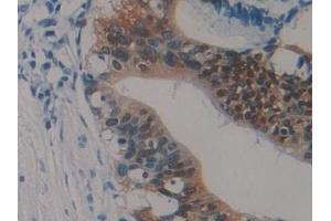 Detection of S100P in Human Pancreatic cancer Tissue using Polyclonal Antibody to S100 Calcium Binding Protein P (S100P) (S100P 抗体  (AA 1-95))