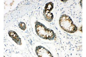 Anti-HYAL1 antibody,  IHC(P) IHC(P): Human Intestinal Cancer Tissue (HYAL1 抗体  (N-Term))