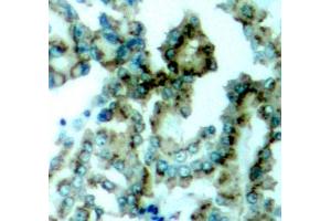 Immunohistochemistry of paraffin-embedded human lung carcinoma tissue, using Phospho-PKCalpha/beta II-T638/641 antibody (ABIN3019760, ABIN3019761, ABIN3019762, ABIN1681948 and ABIN1681949). (PRKCA/PRKCB (pThr638), (pThr641) 抗体)