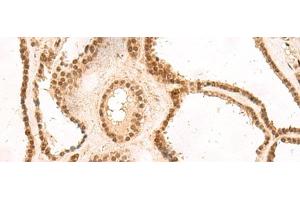 Immunohistochemistry of paraffin-embedded Human thyroid cancer tissue using MKX Polyclonal Antibody at dilution of 1:60(x200) (MKX 抗体)