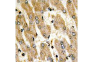 Immunohistochemical analysis of Fibronectin staining in human liver cancer formalin fixed paraffin embedded tissue section. (Fibronectin 抗体  (C-Term))