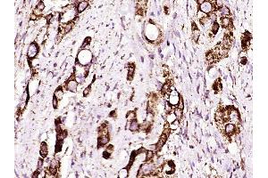 Paraformaldehyde-fixed, paraffin embedded human gastric cancer, Antigen retrieval by boiling in sodium citrate buffer (pH6) for 15min, Block endogenous peroxidase by 3% hydrogen peroxide for 30 minutes,  Blocking buffer (normal goat serum) at 37°C for 20min, Antibody incubation with ADAM17 (Thr735) Polyclonal Antibody (bs-12477R) at 1:400 overnight at 4°C, followed by a conjugated secondary and DAB staining. (ADAM17 抗体  (pThr735))