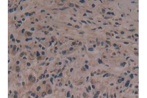 Detection of ANO6 in Human Prostate cancer Tissue using Polyclonal Antibody to Anoctamin 6 (ANO6)