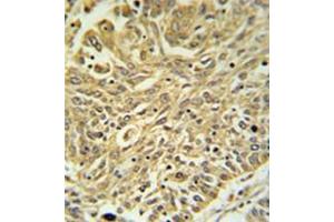 Immunohistochemistry analysis in formalin fixed and paraffin embedded lung carcinoma reacted with GSTK1 Antibody (Center) followed by peroxidase conjugation of the secondary antibody and DAB staining. (GSTK1 抗体  (Middle Region))