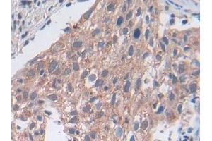 Detection of UTRN in Human Lung cancer Tissue using Polyclonal Antibody to Utrophin (UTRN) (Utrophin 抗体  (AA 1-252))