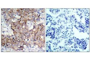 Immunohistochemical analysis of paraffin-embedded human breast carcinoma tissue, using HER2 (phospho- Tyr877) antibody (E011075). (ErbB2/Her2 抗体  (pTyr877))