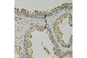 Immunohistochemistry of paraffin-embedded human prostate using FABP1 Antibody (ABIN5973056) at dilution of 1/100 (40x lens). (FABP1 抗体)