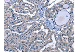 The image on the left is immunohistochemistry of paraffin-embedded Human thyroid cancer tissue using (LRRK2 Antibody) at dilution 1/30, on the right is treated with fusion protein. (LRRK2 抗体)