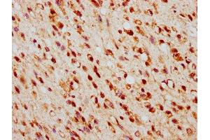 IHC image of ABIN7172910 diluted at 1:500 and staining in paraffin-embedded human glioma performed on a Leica BondTM system. (TSNAX 抗体  (AA 1-87))