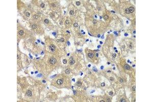 Immunohistochemistry of paraffin-embedded Human liver damage using MAT1A Polyclonal Antibody at dilution of 1:100 (40x lens). (MAT1A 抗体)