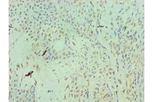 Immunohistochemistry of paraffin-embedded human breast cancer using ABIN7154577 at dilution of 1:100 (RAN 抗体  (AA 1-216))