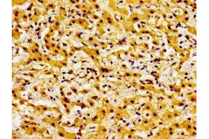 Immunohistochemistry of paraffin-embedded human liver cancer using ABIN7145314 at dilution of 1:100